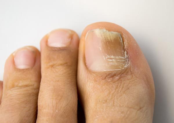 Laser Treatment for Fungal Nails
